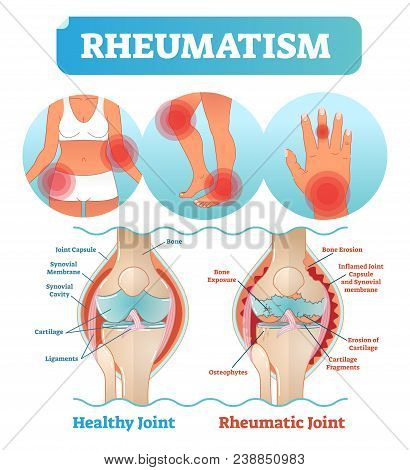 Rheumatism Medical Health Care Vector Illustration Poster Diagram With Damaged Knee Erosion And Pain