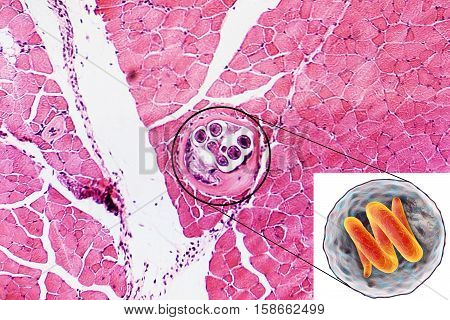 3D illustration and micrograph, transverse section, of cyst in muscle containing helminth Trichinella spiralis, nematode larval cyst in muscle tissue, transmitted by ingestion of undercooked meat