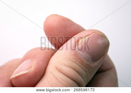 Close Up Of Nail Fungus Infection On The Thumb Finger. Fungal Infection On Nails Hand, Finger With O