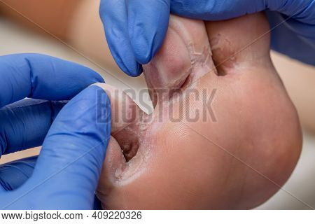 A Podiatrist Examines A Sore Foot With Hyperhidrosis. Damaged Skin With Cracks. Medical Pedicure In 