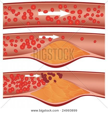 Placa de colesterol en la ilustración de arterias (ateroesclerosis). Arteria superior es saludable. Medio & inferior 