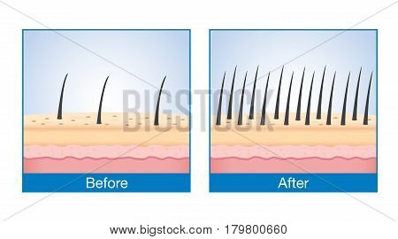 Number of Hair on scalp before and after of treatment hair loss.