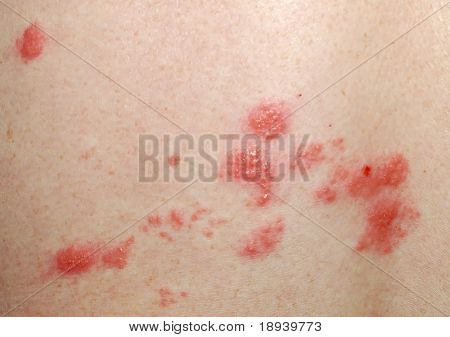 Shingles sores