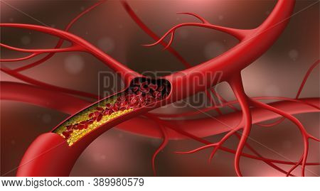 Artery Blocked By Cholesterol. Red Blood Cells In An Artery Blocked By Cholesterol Vector Illustrati