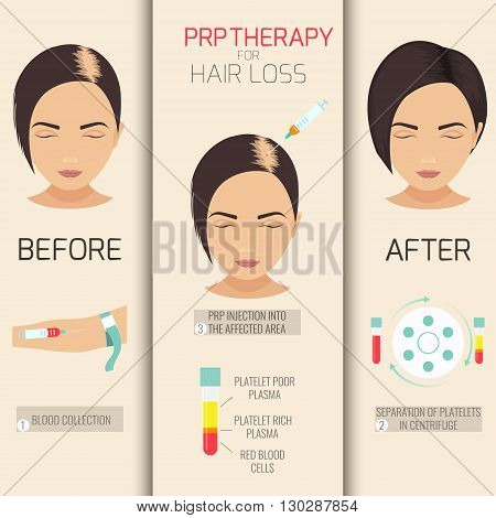 Platelet rich plasma injection. PRP therapy process. Female hair loss treatment infographics. Meso therapy. Hair growth stimulation. Vector illustration.