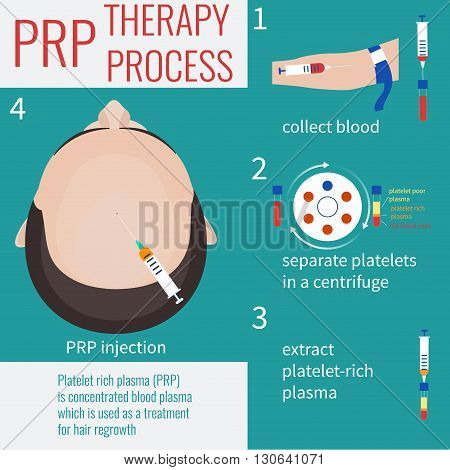 Platelet rich plasma injection. PRP therapy process. Male hair loss treatment infographics. PRP injection. PRP procedure.  Meso therapy. Hair growth stimulation. Male alopecia. Vector illustration.