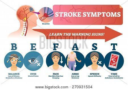 Stroke Symptoms Vector Illustration. Warnings Of Sudden Blood Clot In Head. Labeled List With Reason