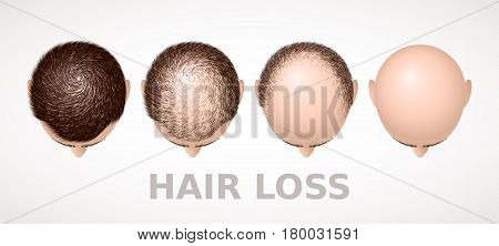 Hair loss. Set of four stages of alopecia. Eps8. RGB Global colors