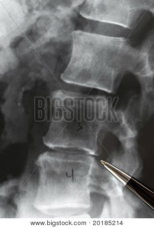 X-ray. Oldalsó ágyéki gerinc