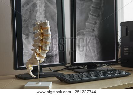 Artificial Human Lumbar Spine Model On The Table With Display Monitor Of Lumbar Spine X-rays