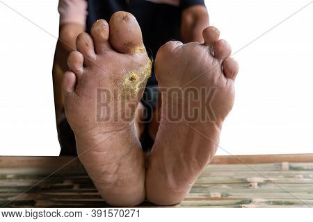 Diabetic Foot, With The Left Foot Cut To Prevent The Spread Of Infection, The Right Foot Is The Infl