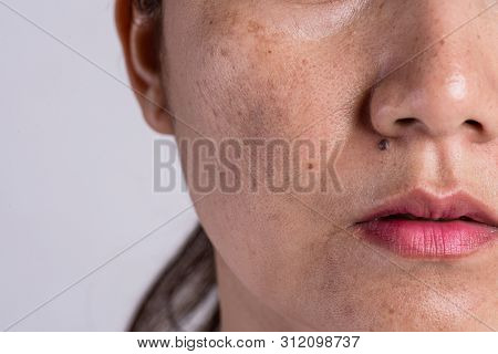 Woman With Problematic Skin And Acne Scars. Problem Skincare And Health Concept. Wrinkles Melasma Da