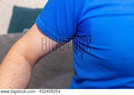 Man With Hyperhidrosis Sweating Very Badly Under Armpit.man Sweating Excessively Smelling Bad At Hom