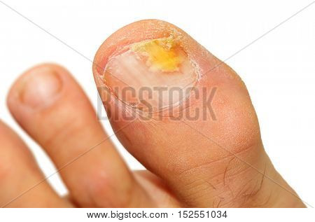 Onychomycosis fungal infection of the nail.  It is the most common disease of the nails. It is an actual skin infection with the Trichophyton rubrum is the most common dermatophyte.