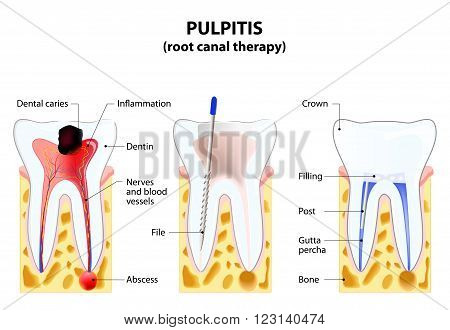 Pulpitis. root canal therapy. Infected pulp is removed from the tooth and the space occupied by it is cleaned and filled with a gutta percha. Post inserted to support crown