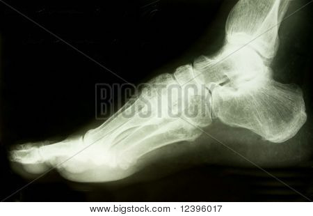 x-ray picture of the foot