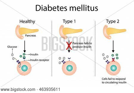 Diabetes Mellitus Type 1, Pancreas's Failure To Produce Enough Insulin And Type 2, Cells Fail To Res