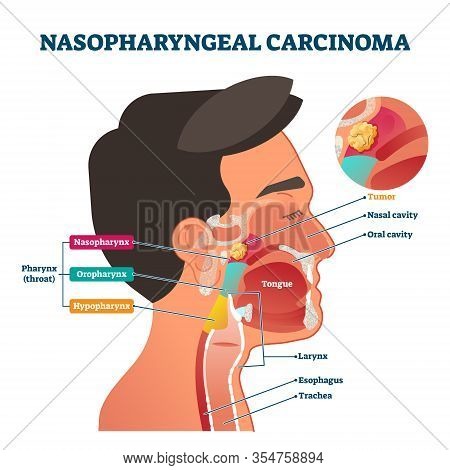 Nasopharyngeal Carcinoma Tumor, Vector Illustration Labeled Diagram. Medical Nose, Mouth And Throat 