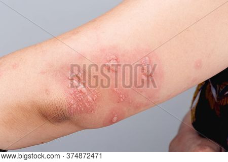 Shingles, Zoster Or Herpes Zoster Symptoms On Arm