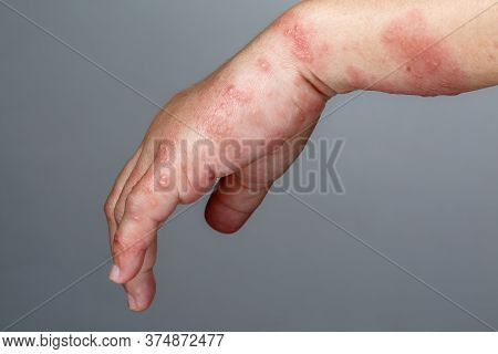 Shingles, Zoster Or Herpes Zoster Symptoms On Arm