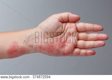 Shingles, Zoster Or Herpes Zoster Symptoms On Arm