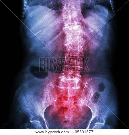 Spondylosis And Scoliosis