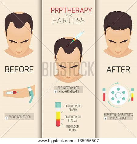 Platelet rich plasma injection. PRP therapy process. Female hair loss treatment infographics. Meso therapy. Hair growth stimulation. Vector illustration.