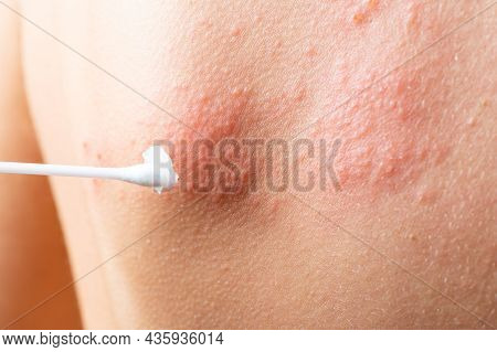 Cotton Swab Treatment Of Skin Rash. Shingles, Varicella-zoster Virus. Skin Rash And Blisters On Body