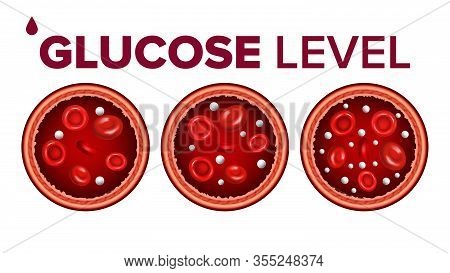 Glucose Sugar Level In Blood And Red Cells Vector. Hypoglycemia, Normal Glucose Level And Hyperglyce