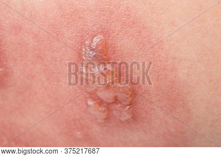 Shingles, Zoster Or Herpes Zoster Symptoms On Arm