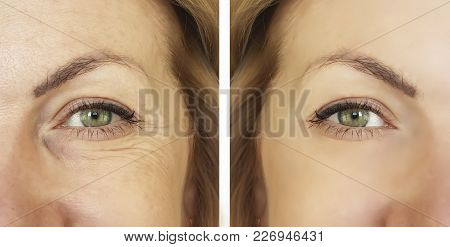 Face Woman Wrinkles Before And After Wrinkled, Elderly, Youth, Lift, Dermatology