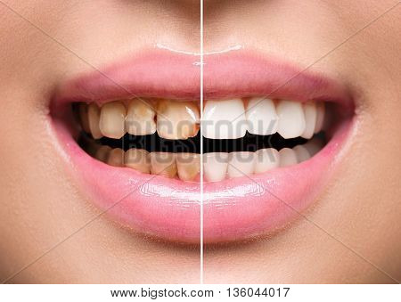 Woman Teeth before and after dental treatment. Teeth Whitening. Happy smiling woman. Dental health Concept. Oral Care, teeth restoration 