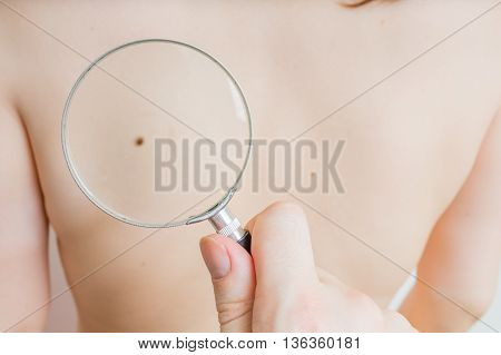 Doctor holds magnifying glass in hand and is examining patient skin for melanoma suspicion.