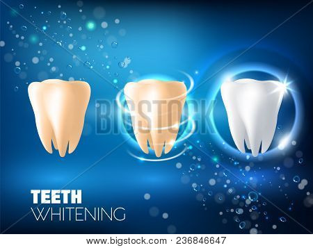 Teeth Whitening Concept Vector Realistic Illustration. Tooth Before Whitening, During And After Whit