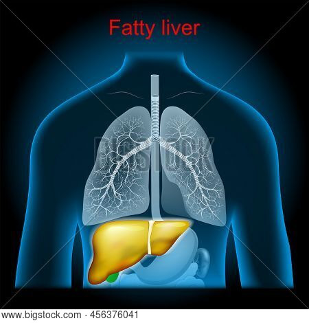 Fatty Liver Disease. Hepatic Steatosis. Excess Fat Builds Up In The Liver, Stomach And Lungs Into X-