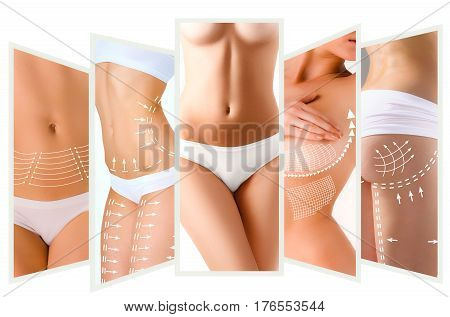 The cellulite removal plan. White markings on young woman body preparing for plastic surgery. Concept of slimming, liposuction, strand lifting