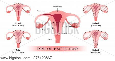 Hysterectomy, Surgical Removal Of The Uterus. Medical Vector Illustration Shows 4 Types Of Hysterect