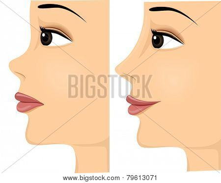 Side View Illustration of a Woman Showing the Difference in Her Nose Before and After Rhinoplasty