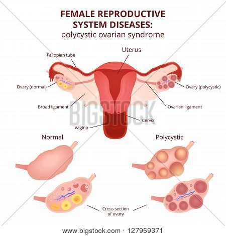 female reproductive system, the uterus and ovaries scheme, polycystic ovary syndrome, ovarian cyst