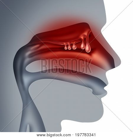 Nasal polyps medical concept as noncancerous swelling and growth as a human sinuses congestion symptom symbol in a 3D illustration style.