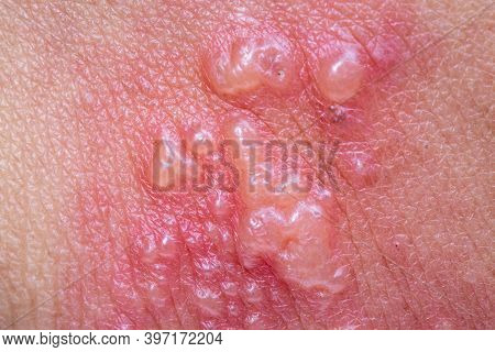 Shingles, Zoster Or Herpes Zoster Symptoms On Arm