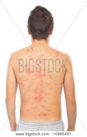 Back Of Man With Chickenpox