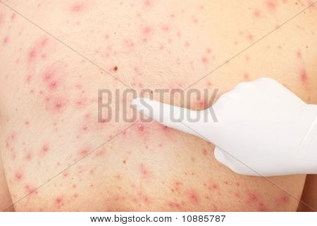 Hand Pointing To Skin Rash