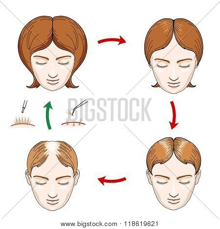 Female hair loss and transplantation icons