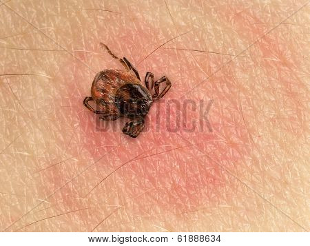 Tick Bite