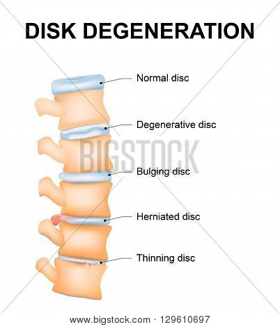 Disc degeneration it's the normal wear and tear process of aging spine. intervertebral discs lose their flexibility elasticity and shock-absorbing characteristics.