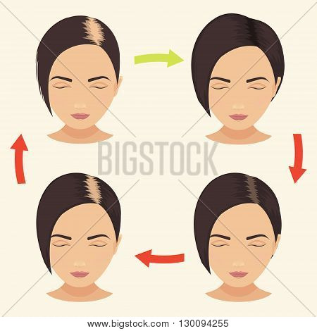 Female hair loss stages set. Woman before and after hair treatment and hair transplantation. Female pattern baldness. Implantation of hair. Vector illustration.