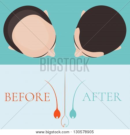 Top view of a man before and after hair treatment and hair transplantation. Implantation of hair. Hair care concept. Hair bulb logo. Hair loss clinic concept design. Isolated vector illustration.