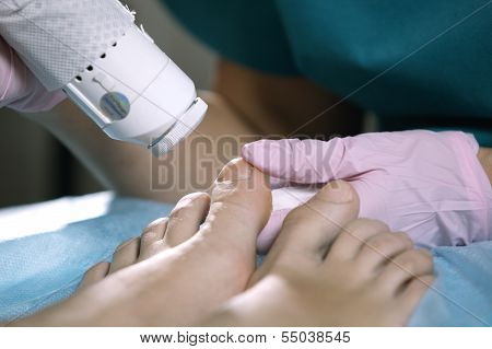 Podiatrist treating onychomycosis with a laser