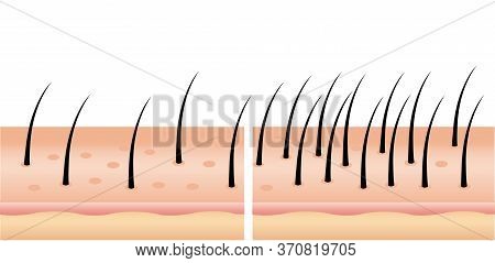 Hair Loss Stages Set Of Before And After Steps. Side View Of A Man Losing Hair Before And After Hair